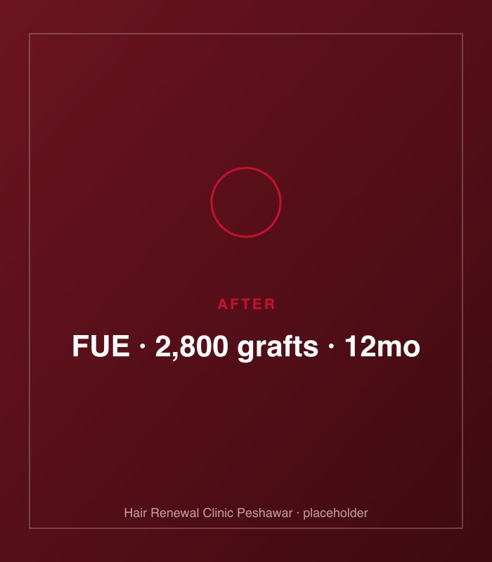 After FUE hair treatment — patient case case-fue-2800-norwood-v
