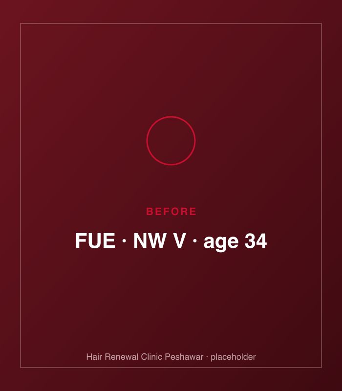 Before FUE hair treatment — patient case case-fue-2800-norwood-v