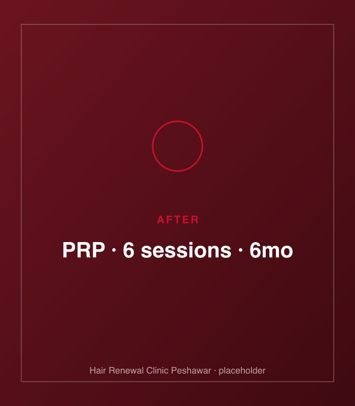 After PRP hair treatment — patient case case-prp-norwood-iii