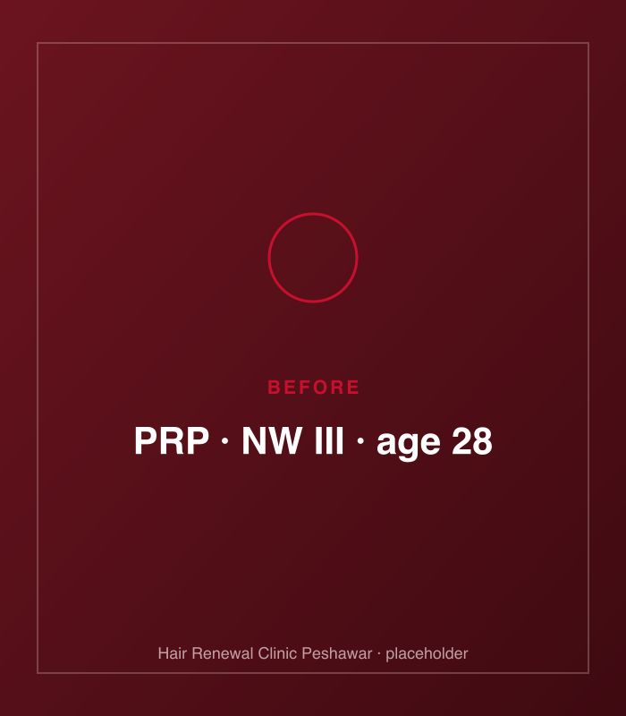 Before PRP hair treatment — patient case case-prp-norwood-iii