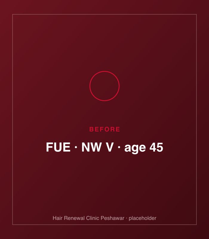 Before FUE hair treatment — patient case case-fue-3200-norwood-v