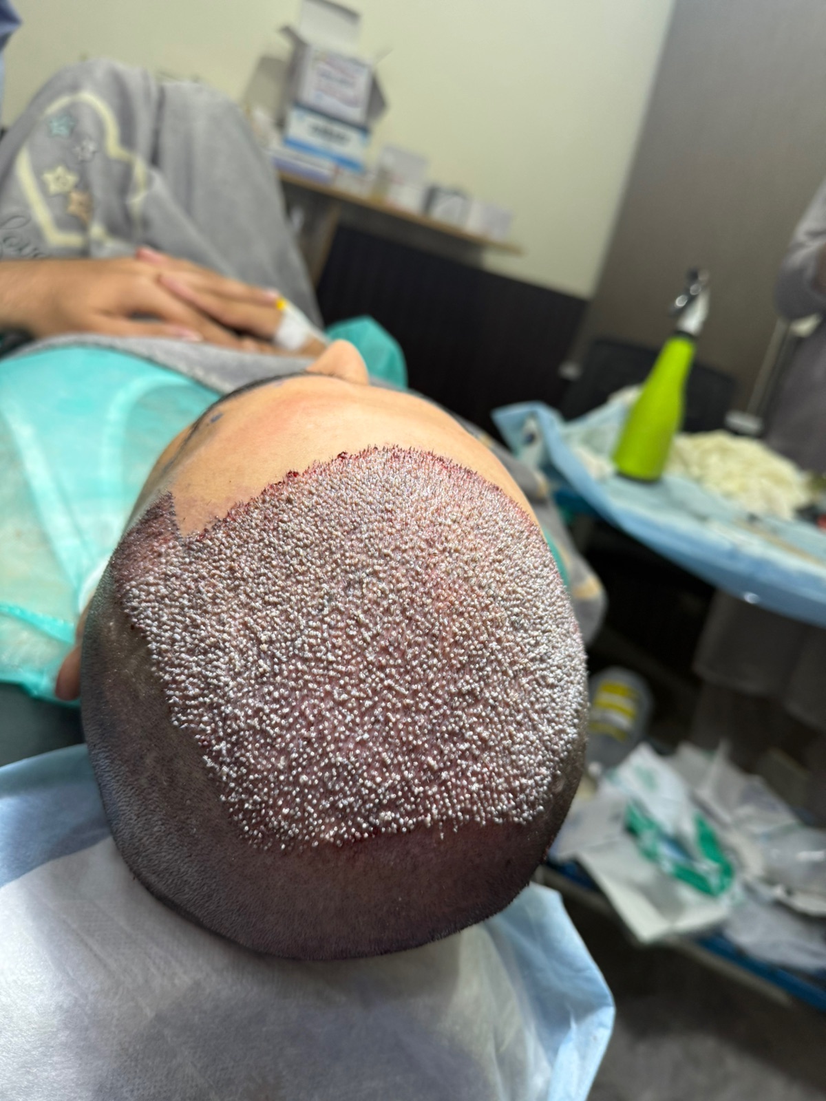 PRP injection being prepared for a hair regrowth session