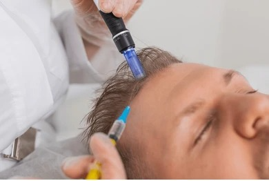 Clinician preparing an exosome therapy treatment for the scalp