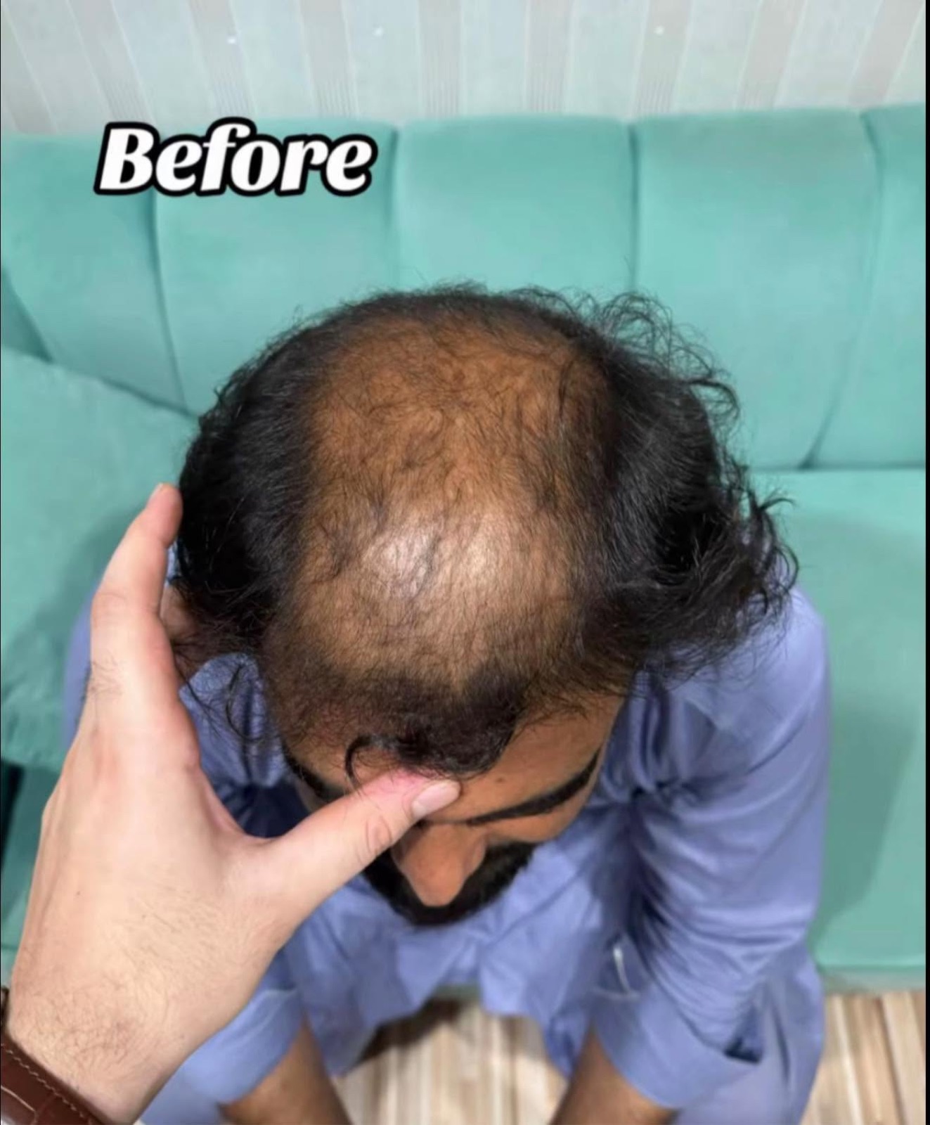 Before Chinese hair treatment — patient case case-chinese-2400-norwood-iv