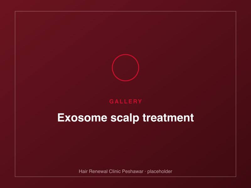 Microneedling delivery of exosomes into the scalp