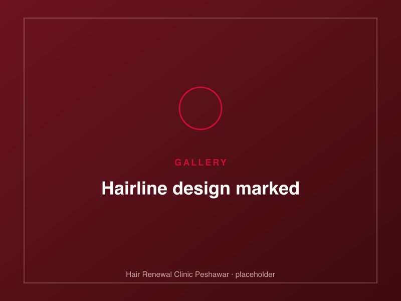 Recipient hairline design marked before the procedure